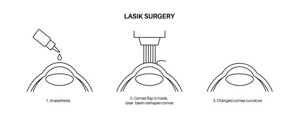 Advantages of fast LASIK surgery