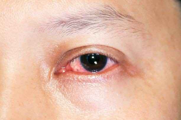 Does Farting Cause Pink Eye
