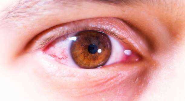 Does Farting Cause Pink Eye