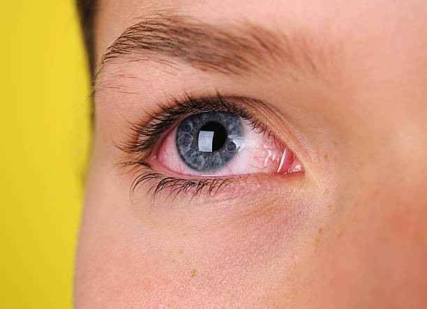 Does Farting Cause Pink Eye