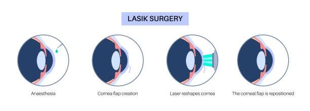 LASIK Eye Surgery