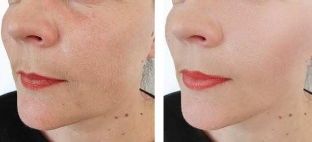 skinpen vs morpheus8