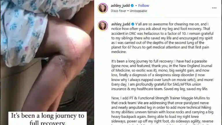 Ashley Judd Instagram screenshot showing her leg scar from her Congo accident.